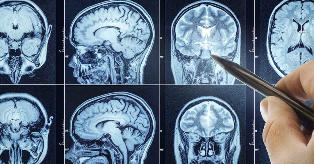 Cheap Supplements Show Early Promise Against Aggressive Brain Tumors - Featured image