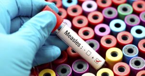 Canada Lost Its Measles Free Status, Is The U.S. Next? hand in a blue glove holding a blood sample tube, likely for diagnostic testing. The image context and search results suggest the sample is being tested for measles.