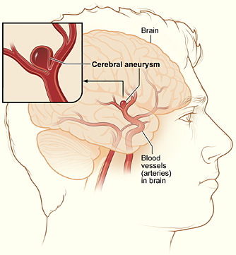Medical illustration of a human head showing a cerebral aneurysm in the brain’s blood vessels.