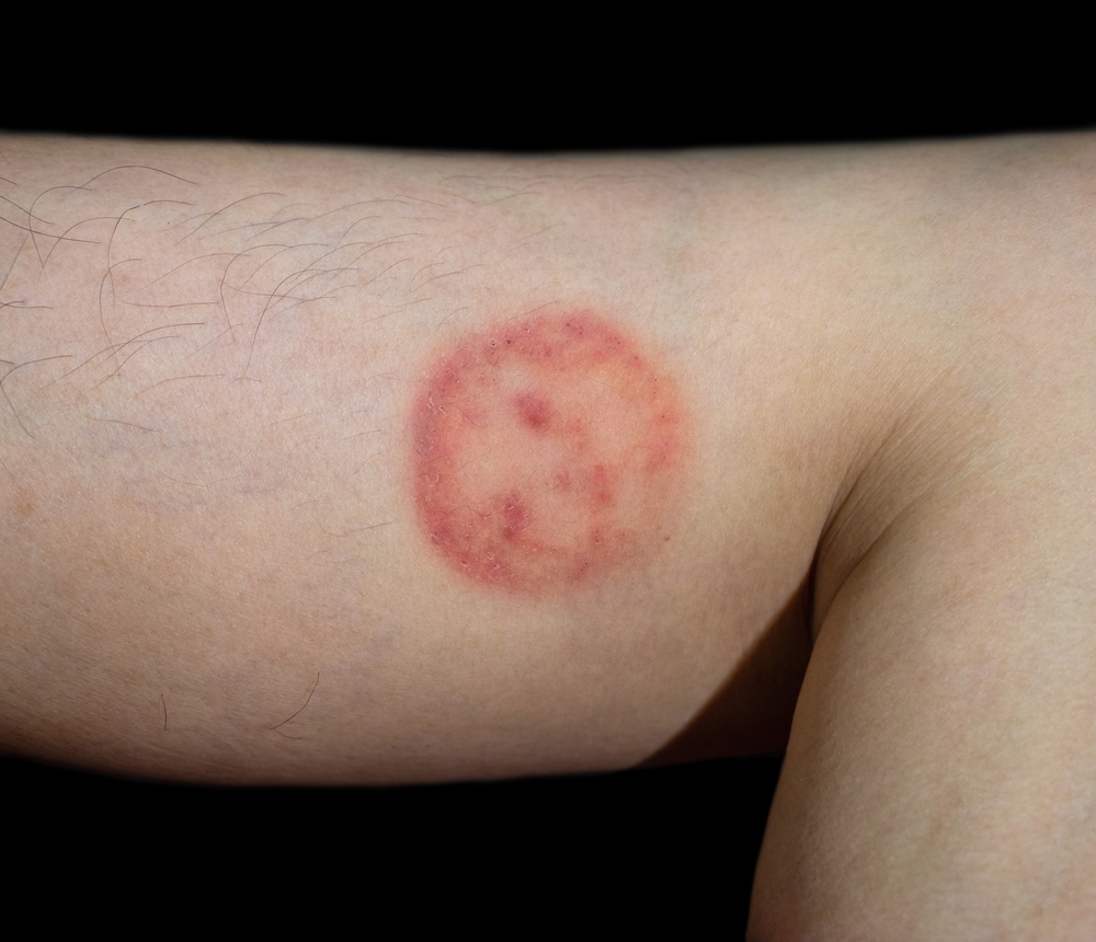 Fungal infection called tinea corporis in Southeast Asian man. Ringworm