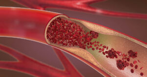 7 Subtle Blood Clot Symptoms Most People Miss digital illustration of a blood vessel with a significant blockage, likely an arterial plaque or blood clot, and presents options for intervention