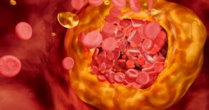 Innovative Nanoparticles Identify and Disarm Heart-Disease-Causing Plaque Blocked artery filled with accumulation of fat, cholesterol plaques, blood clots, unhealthy foods, and sugary beverages, illustrating risks of heart disease, stroke, and vascular damage. 3D rendering.