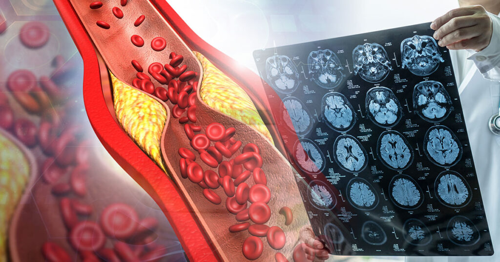 3 Morning Habits to Avoid if You Have High Blood Pressure or Cholesterol - Featured image