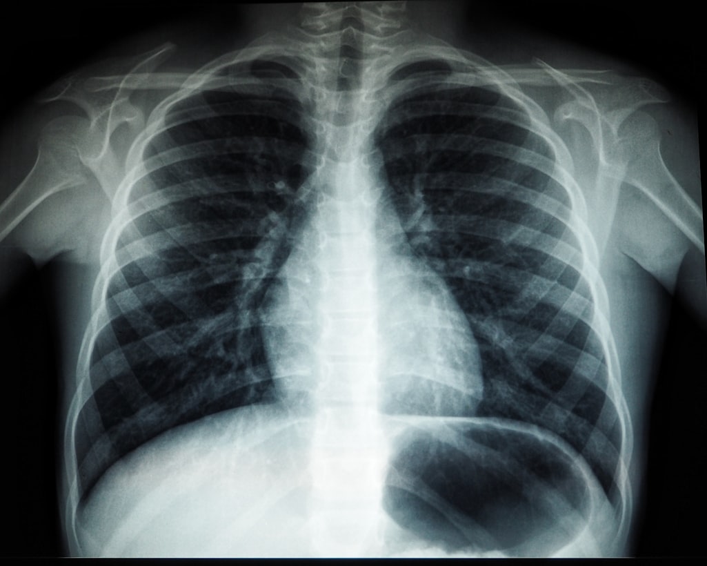 A chest X-ray showing the ribcage, lungs, and spine in typical grayscale medical imaging.