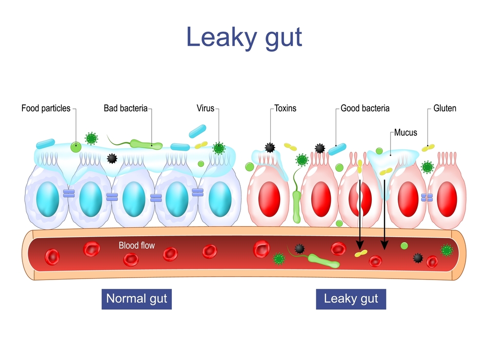 Leaky gut Syndrome. difference between Healthy cells, and inflamed intestinal cells. Intestinal permeability. Gut barrier dysfunction. Intestinal inflammation. Vector poster