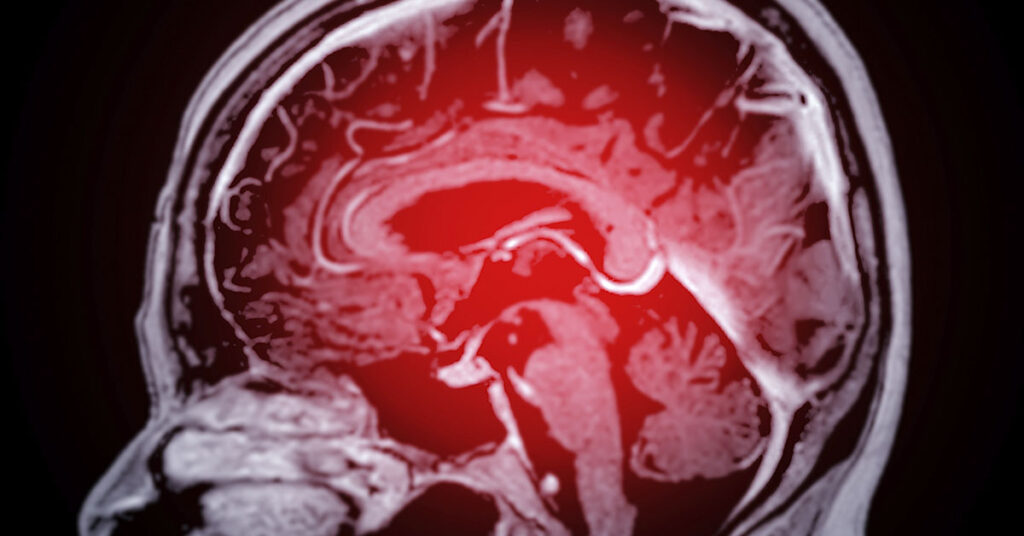 Family of 24-Year-Old Who Died From Young-Onset Dementia Share the First Symptoms They Noticed - Featured image