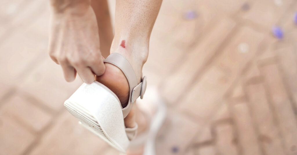 Blood Blisters: Causes, Symptoms, and When to See a Doctor - Featured image