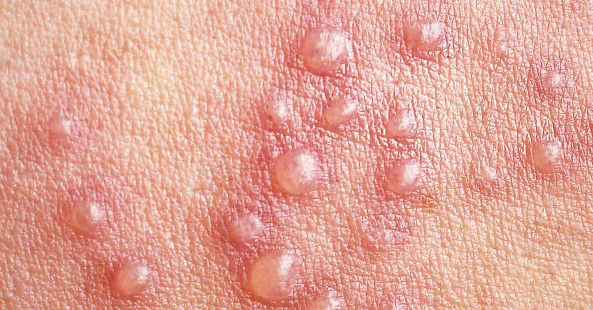 The Virus That Lurks for Years Until Your Body Can No Longer Keep It in Check