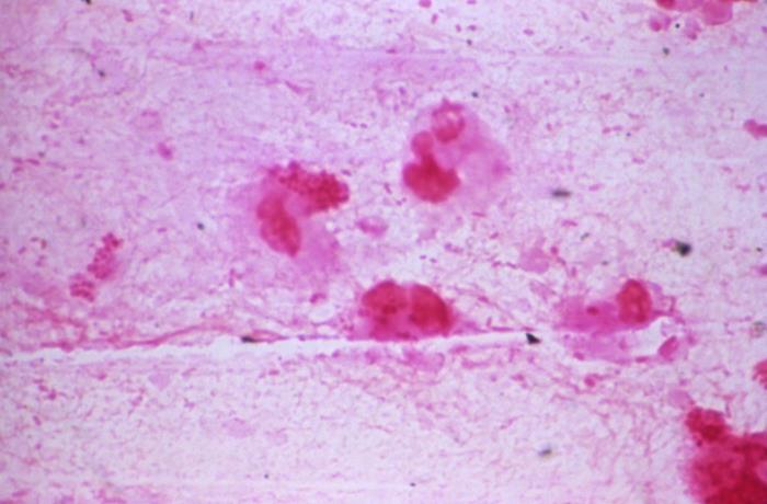 Light microscope image of Neisseria meningitidis bacteria stained pink and red, showing the characteristic paired circular cells scattered across a pale background with some white blood cells visible.