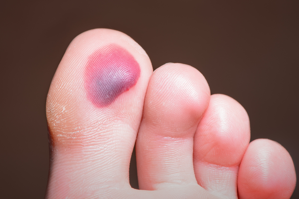 Blood blister, footsore on the skin of the foot