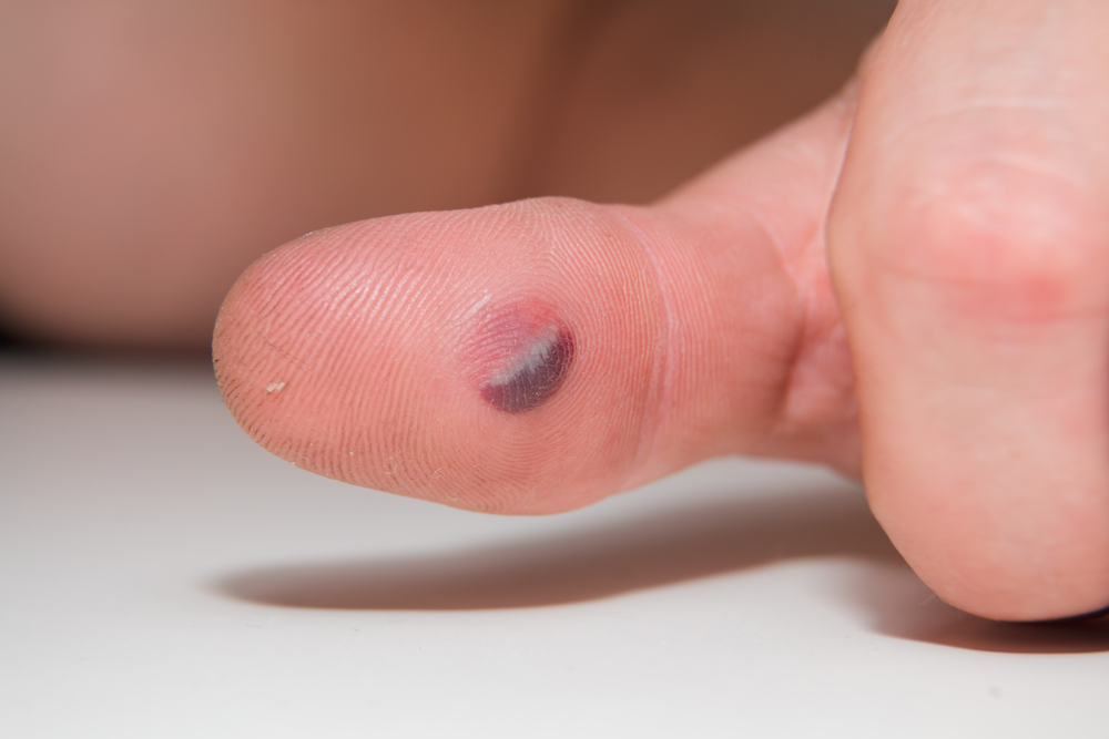 Blood blister under the thumb skin. Caucasian young man finger on white background