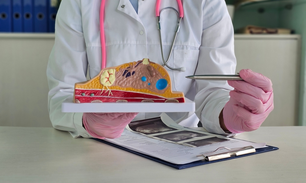 A doctor showing a breast tumor or cancer on an anatomical model of the breast to educate women about the prevention and treatment of breast diseases..