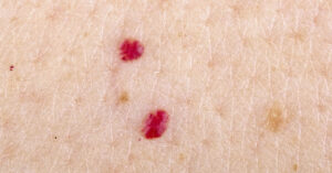 Noticing Tiny Red Dots on Your Skin? Here’s What a Dermatologist Wants You to Know Close up of red dots on skin, possible cherry angioma
