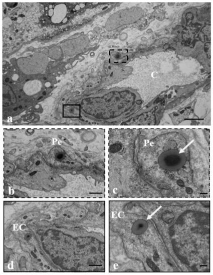 A series of electron microscopy panels showing microplastic particles lodged inside the fetal blood vessels of a human placenta. White arrows point to the plastic fragments sitting within the pericytes and endothelial cells that line the vessels connecting to the developing baby. The surrounding tissue shows signs of cellular stress.