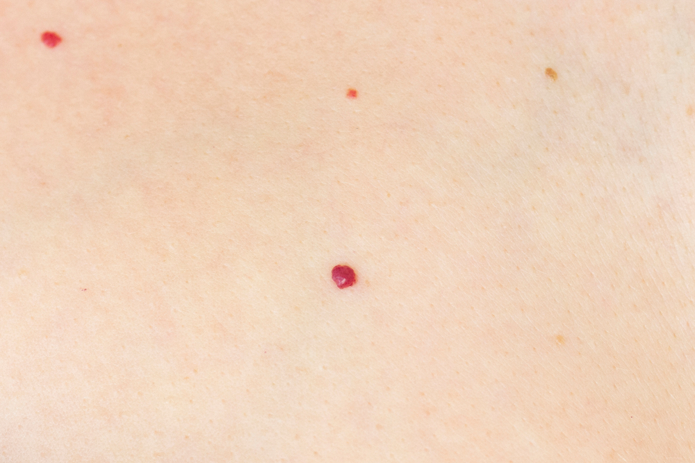 angioma. red mole on the skin. bursting vessel capillary. many angiomas in a small area of the body. close-up.