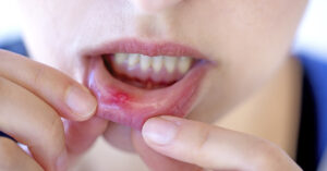 5 Possible Reasons You Have a Lump or Growth in Your Mouth close up of person showing inside of lips revealing a red sore
