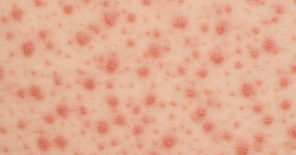 7-Year-Old Boy Dies from Brain Complication Linked to Highly Contagious Childhood Disease - Featured image