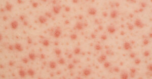 7-Year-Old Boy Dies from Brain Complication Linked to Highly Contagious Childhood Disease close up of measles rash