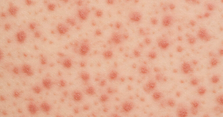 7-Year-Old Boy Dies from Brain Complication Linked to Highly Contagious Childhood Disease - Featured image