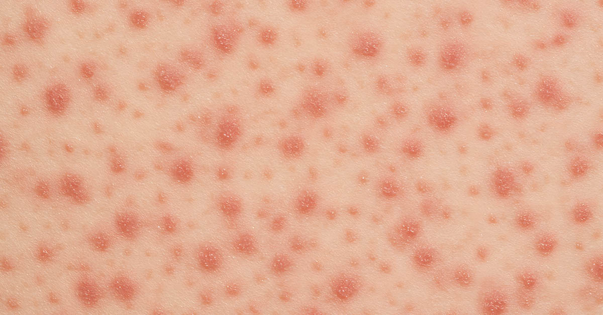 7-Year-Old Boy Dies from Brain Complication Linked to Highly Contagious Childhood Disease