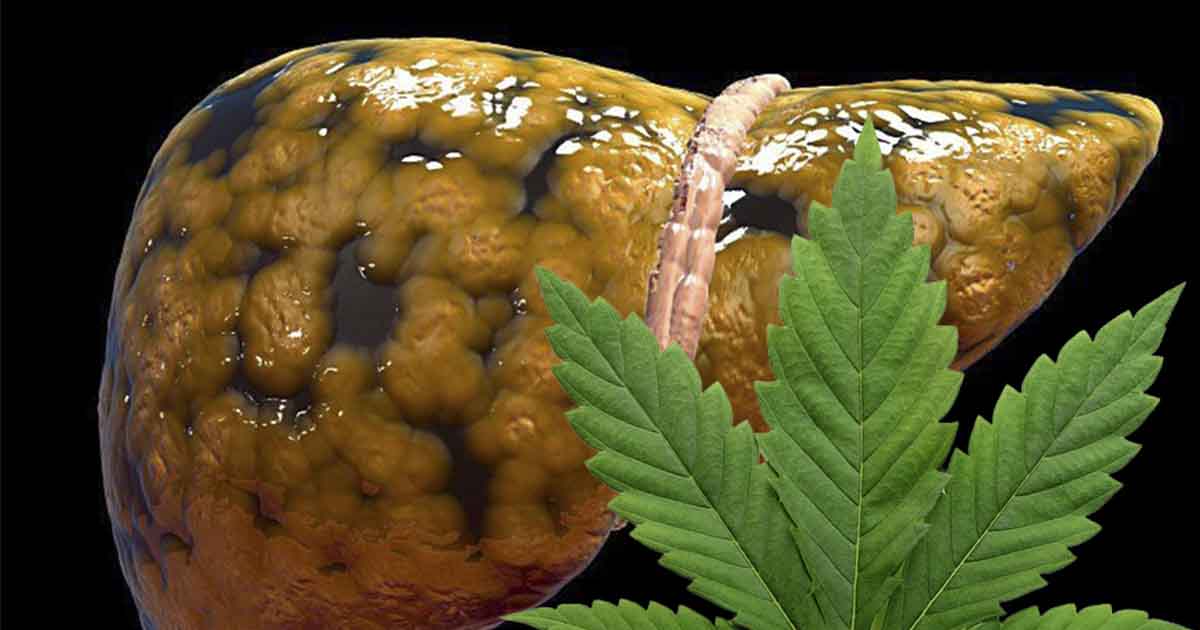 Cannabis Compounds Show Promise for Fatty Liver