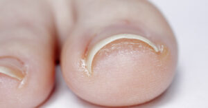 Close up of top of large toe with toenail curling into the skin. In grown toenail concept