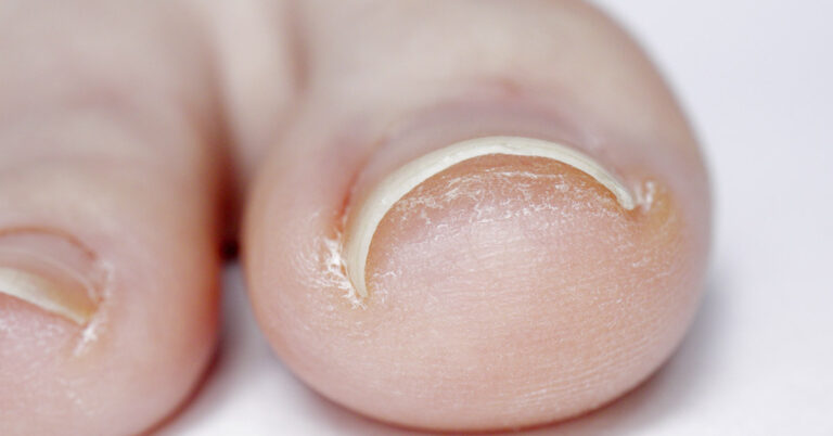 Why Do Toenails Curl and Dig Into the Skin as We Get Older? - Featured image