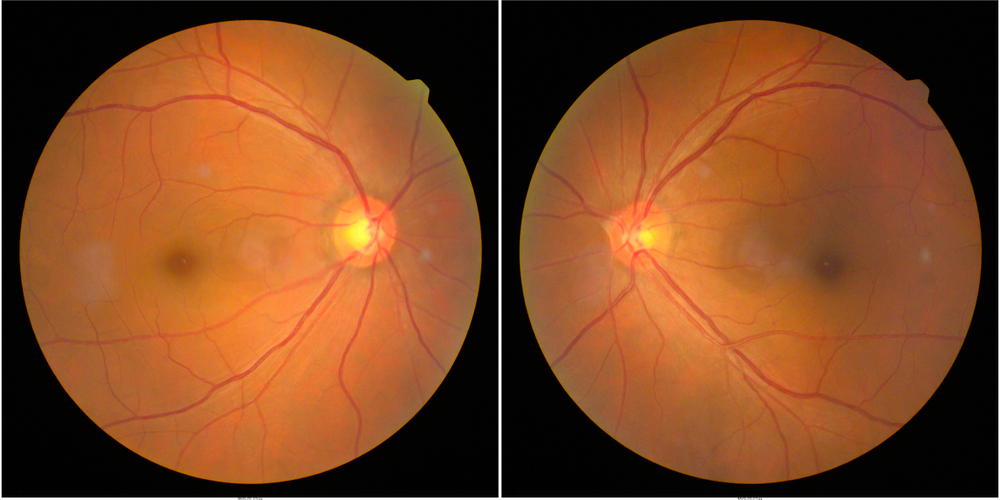 collection of Retinal image of the patient taken with retinal photography machine.