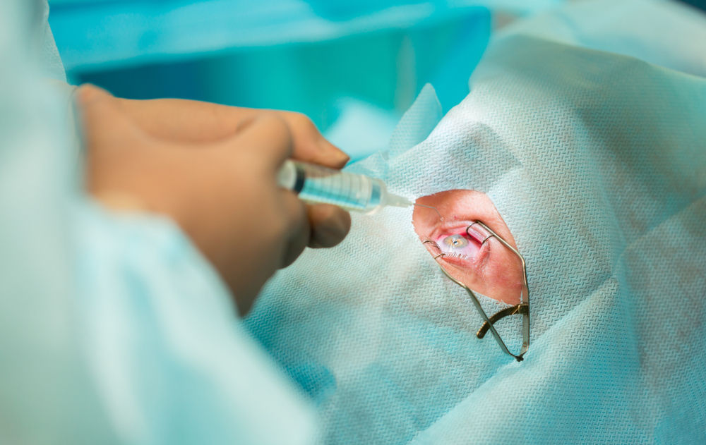 Eye surgery. Surgery to improve vision. Doctor surgeon performs cataract surgery, treatment of myopia. Hospital staff in the operating room.