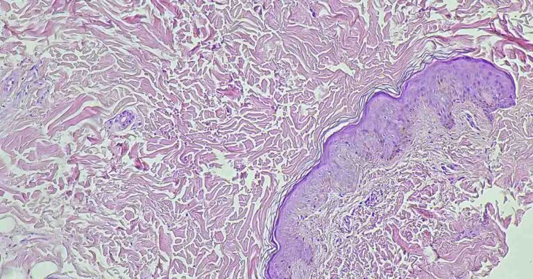 Scientists Find Antioxidant May Feed Tumor Growth - Featured image