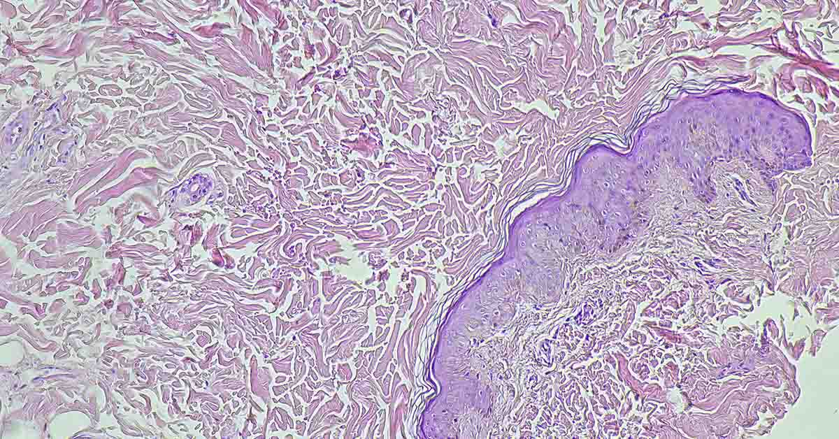 Scientists Find Antioxidant May Feed Tumor Growth