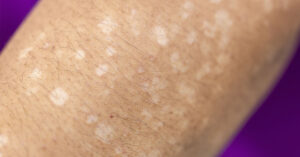 Noticing Small White Spots on Your Arms or Legs? Here’s What They Could Mean close up, white spots on arm