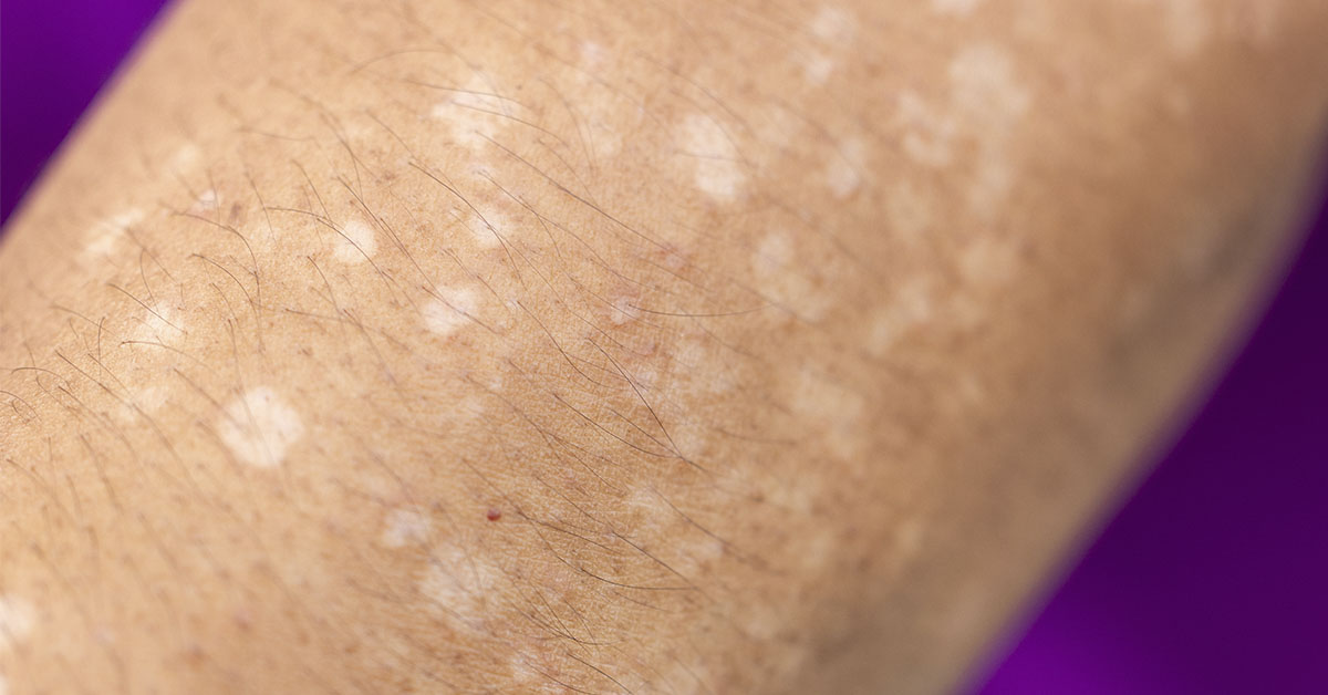 Noticing Small White Spots on Your Arms or Legs? Here’s What They Could Mean