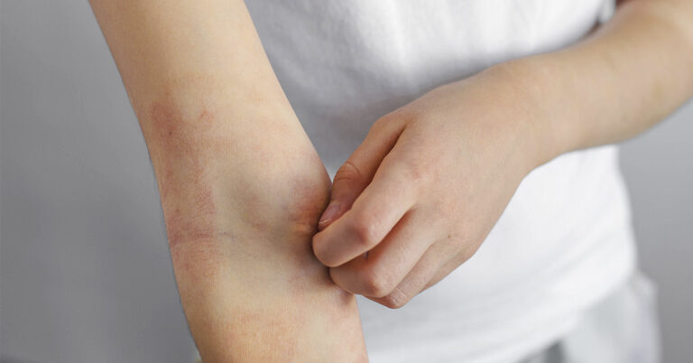 8 Surprising Hives Triggers You Might Be Overlooking - Featured image