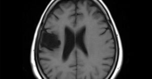 Scientists May Have Identified What’s Driving Brain Cell Death in Alzheimer’s - And How to Stop It axial Brain MRI scan showing a lesion on the left side of the brain.