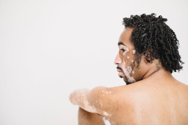 man with vitiligo