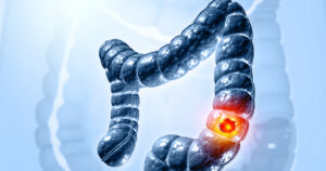 colorectal cancer