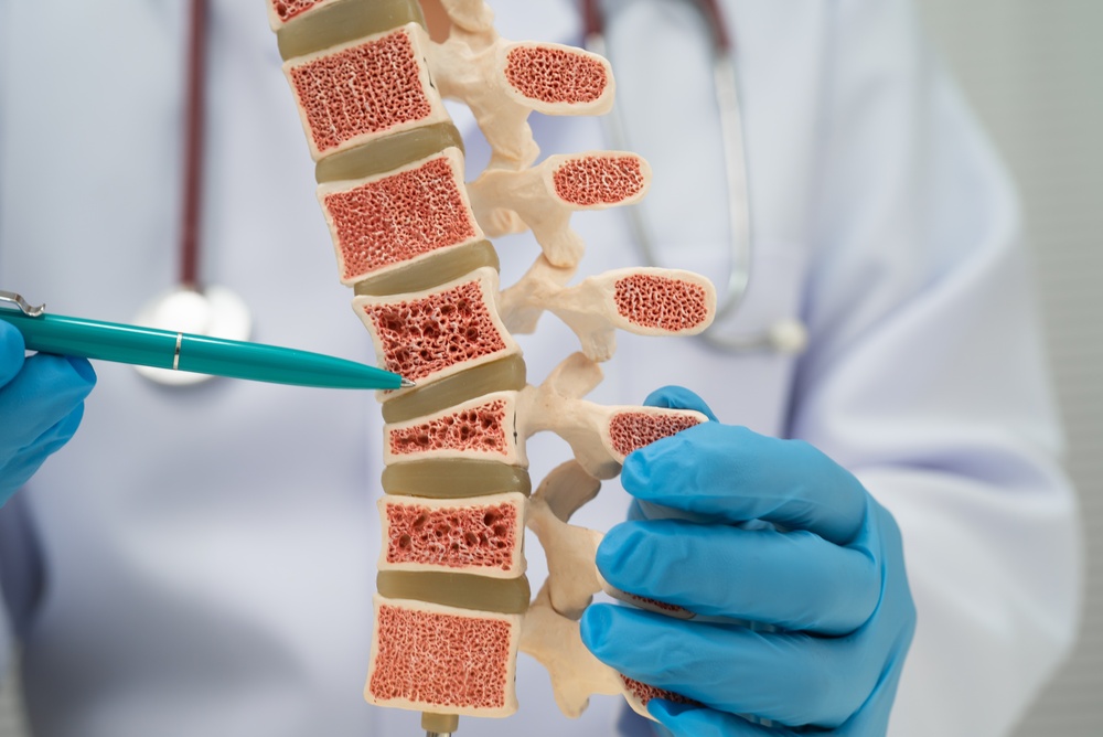 Doctor holding osteoporosis in back bone model for treatment medical in orthopedic department.