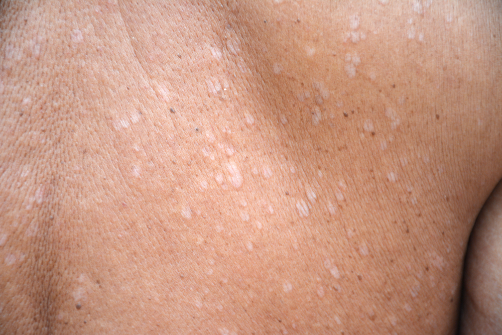 Tinea versicolor/Pityriasis versicolor on the skin