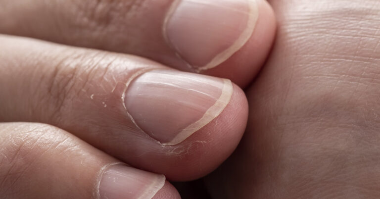 What the Lines on Your Nails Could Be Telling You About Your Health - Featured image