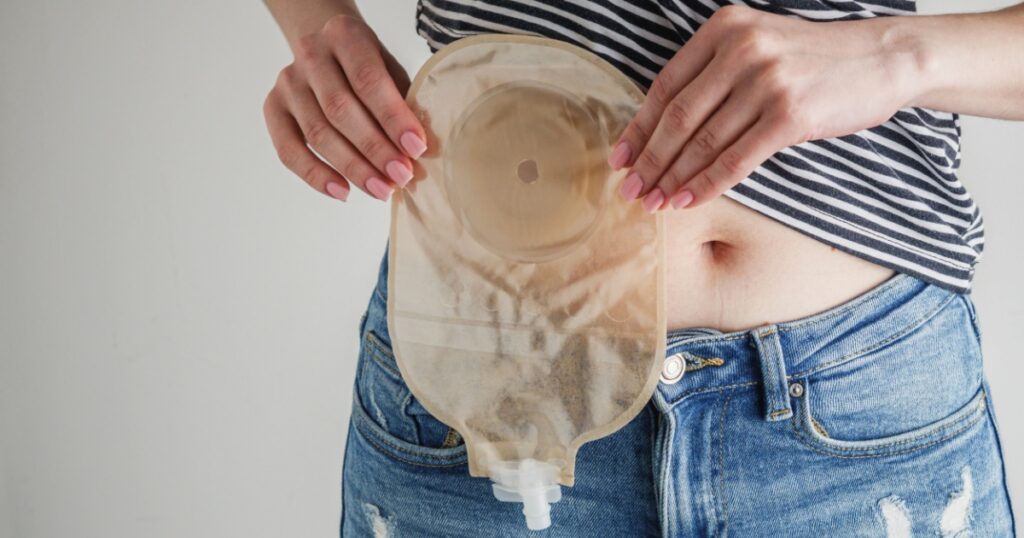 E. coli Toxin May Be Driving Increase in Colon Cancer Among Younger Adults - Featured image