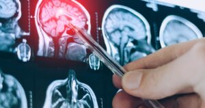 New Brain-Based Cause of High Blood Pressure Discovered CT scan image of human brain. Mri or x-ray scan for diagnostic human head diseases