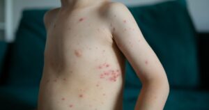 The Childhood Virus Silently Linked to Dementia — And What to Do About It Child torso covered with chickenpox rash. Skin with red itchy blisters caused by varicella virus. Pediatric infectious disease symptoms.