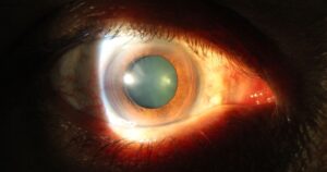 Simple Test That May Predict Death Within 24 Hours Macro photograph of a moderately dilated pupil showing cortical cataract changes.
