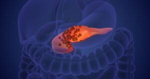 Cancer cell proliferation and injury to the pancreas 3D Illustration
