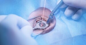 Process laser vision correction, lasik treatment. Doctor use equipment for fixing eyeball, patient under sterile cover.