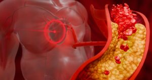 Study Suggests 'Silent' Inflammation Could Be a Driver of Heart Disease Vascular damage, artery clogging, and plaque buildup from junk food, high sugar consumption, processed foods, alcohol abuse, and poor lifestyle choices affecting heart health. 3D Rendering