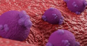 From Gut Bacteria to DNA Repair: The Discoveries Reshaping Ovarian Cancer Research Cancerous tissue destroying human cell, tumor concept. Ovarian malignant tumor, Female uterus anatomy, Reproductive system, cancer cells, ovaries cysts, metastasis cancerous, duplicating. 3d render