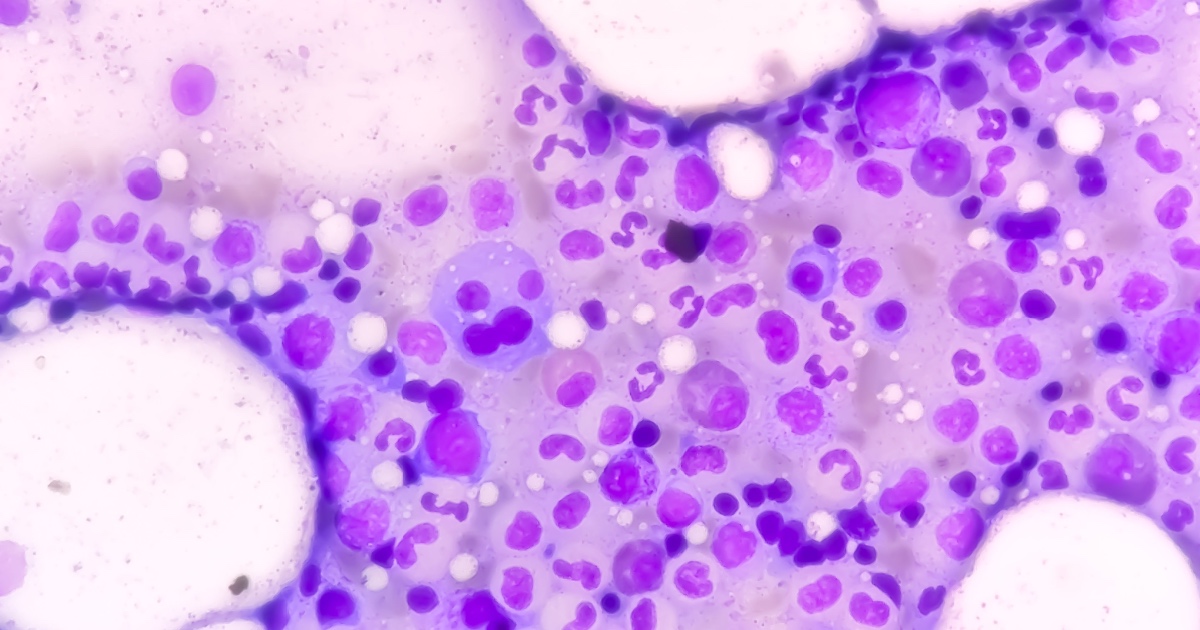 The New Rule That’s Changing How Doctors Catch the Deadliest Myeloma
