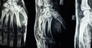 Missed Fracture Warning Signs May Leave People With Undiagnosed Bone Disease Close-up X-ray showing detailed view of human hand bones.